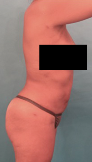 Liposuction Patient #22 After Photo # 14