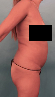 Liposuction Patient #22 Before Photo # 13