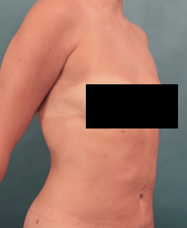 Liposuction Patient #25 After Photo Thumbnail # 16