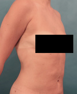 After Image: Liposuction Patient #25 -