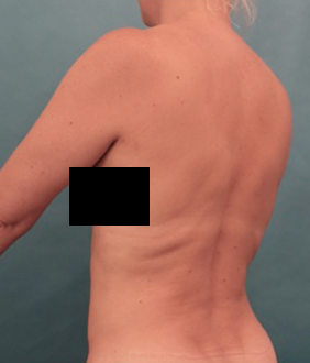 After Image: Liposuction Patient #25 -