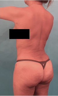 Liposuction Patient #22 After Photo # 8