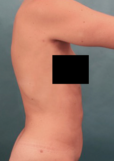 After Image: Liposuction Patient #25 -