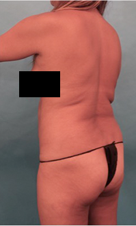 Liposuction Patient #22 Before Photo # 7