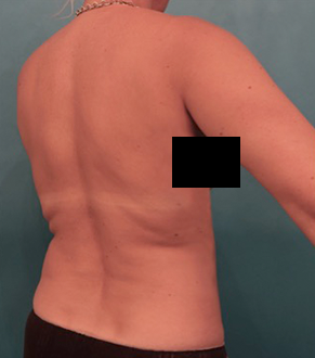 Before Image: Liposuction Patient #25 -