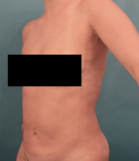 After Image: Liposuction Patient #25 -