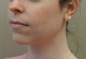 Kybella Patient #17 After Photo Thumbnail # 4