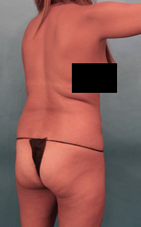 Liposuction Patient #22 Before Photo # 11