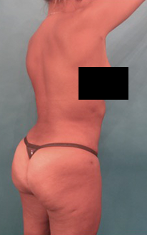 Liposuction Patient #22 After Photo # 12