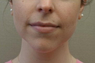 Kybella Patient