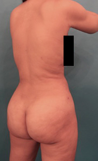 Liposuction Patient #24 After Photo Thumbnail # 6