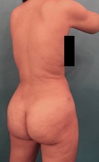 After Image: Liposuction Patient #24 - 