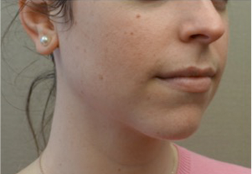 Kybella Patient #17 After Photo # 8