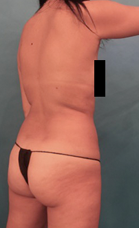 Liposuction Patient #24 Before Photo # 5