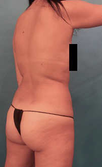 Before Image: Liposuction Patient #24 - 