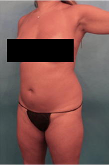 Liposuction Patient #22 Before Photo # 3