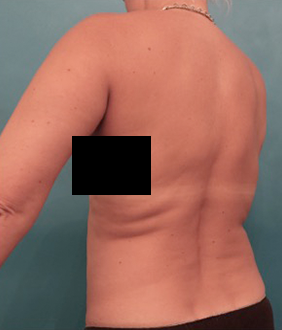 Before Image: Liposuction Patient #25 -
