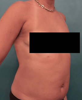 Before Image: Liposuction Patient #25 -