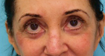 Lower Eyelid Blepharoplasty Patient #4 After Photo # 2