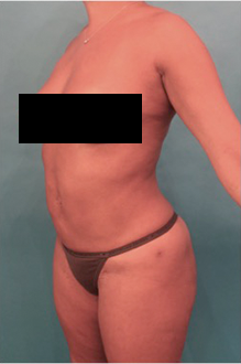 Liposuction Patient #22 After Photo # 4