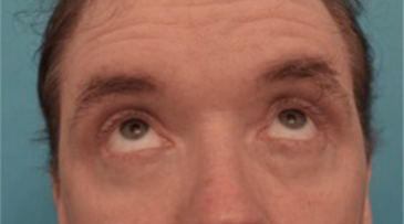 Male Blepharoplasty Patient #2 After Photo Thumbnail # 4