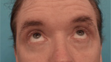 Male Blepharoplasty Patient #2 After Photo # 4