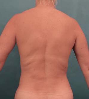 After Image: Liposuction Patient #25 -