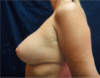 Breast Augmentation (Implants) Patient #17 After Photo Thumbnail # 10