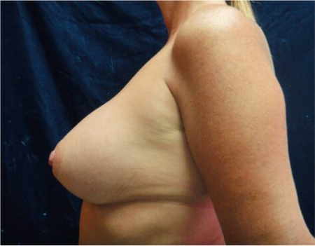 Breast Augmentation (Implants) Patient #17 After Photo # 10