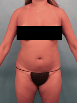 Liposuction Patient #22 Before Photo # 1