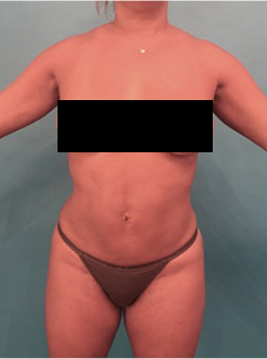 Liposuction Patient #22 After Photo Thumbnail # 2