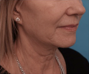 Jowl/Jawline Contouring Kybella Patient #3 Before Photo # 7