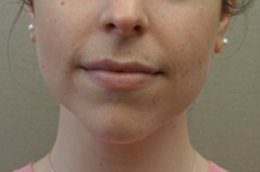 Jowl/Jawline Contouring Kybella Patient #5 After Photo Thumbnail # 2