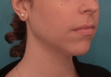 Jowl/Jawline Contouring Kybella Patient #5 Before Photo # 7