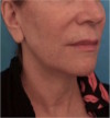 Jowl/Jawline Contouring Kybella Patient #4 Before Photo Thumbnail # 5