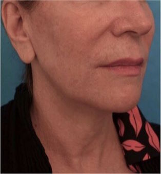 Jowl/Jawline Contouring Kybella Patient #4 Before Photo # 5