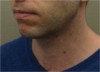 Male Kybella Patient #2 After Photo Thumbnail # 4