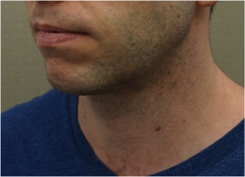 Male Kybella Patient #2 After Photo # 4