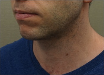 After Image: Male Kybella Patient #2 - 