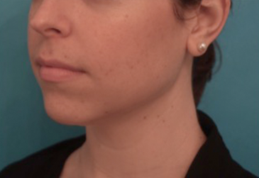 Jowl/Jawline Contouring Kybella Patient #5 Before Photo Thumbnail # 3