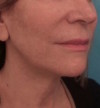 Jowl/Jawline Contouring Kybella Patient #4 After Photo Thumbnail # 6