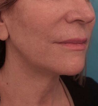 Jowl/Jawline Contouring Kybella Patient #4 After Photo # 6
