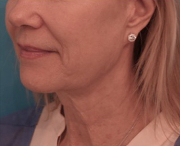 Jowl/Jawline Contouring Kybella Patient #3 After Photo # 10