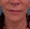 Jowl/Jawline Contouring Kybella Patient #4 Before Photo Thumbnail # 1