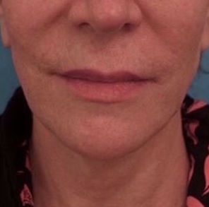 Jowl/Jawline Contouring Kybella Patient #4 Before Photo # 1