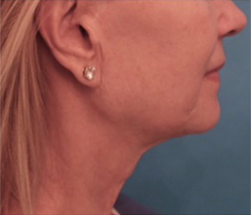 Jowl/Jawline Contouring Kybella Patient #3 After Photo # 4