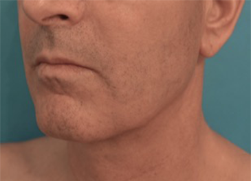 Jowl/Jawline Contouring Kybella Patient #2 After Photo # 6