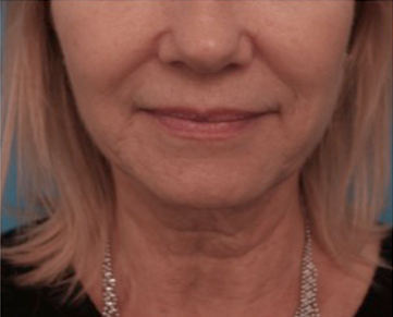 Jowl/Jawline Contouring Kybella Patient #3 Before Photo # 1