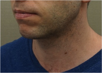 Kybella Patient #7 After Photo # 4