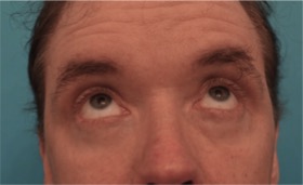 Upper and Lower Eyelid Blepharoplasty #6 After Photo # 4